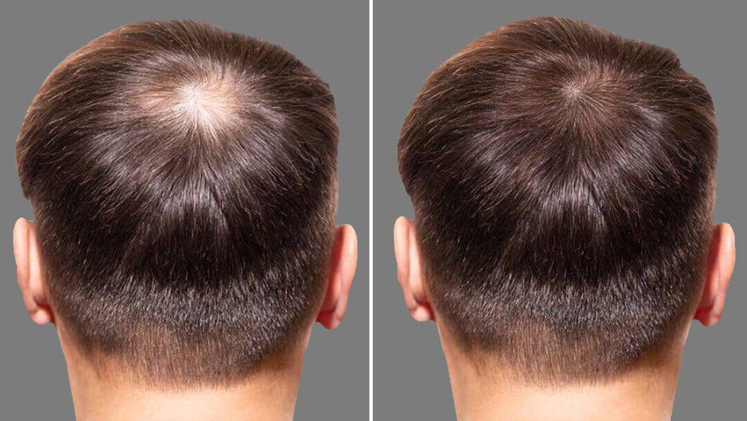 Здоровий зростання волосся з Minoxidil для чоловіків і жінок.