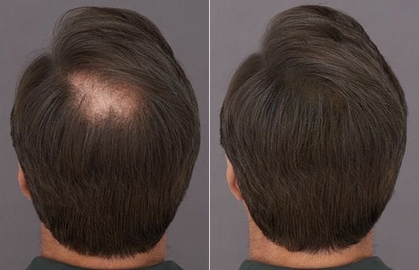 Втрата волосся до і після використання міноксидил.